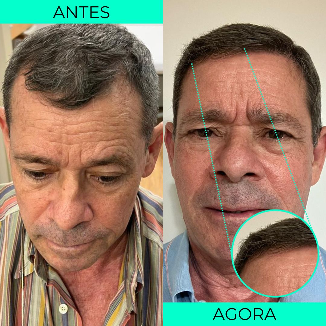 Dr. Pedro Almeida Transplante capilar